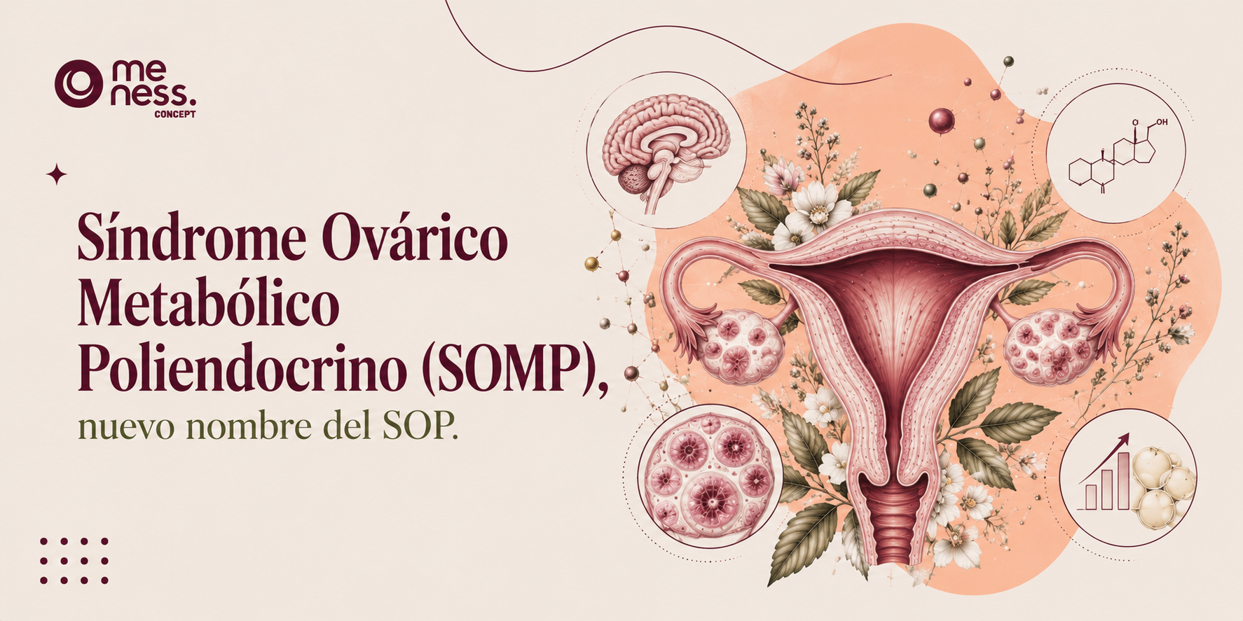 Síndrome Ovárico Metabólico Poliendocrino (SOMP), nuevo nombre del SOP